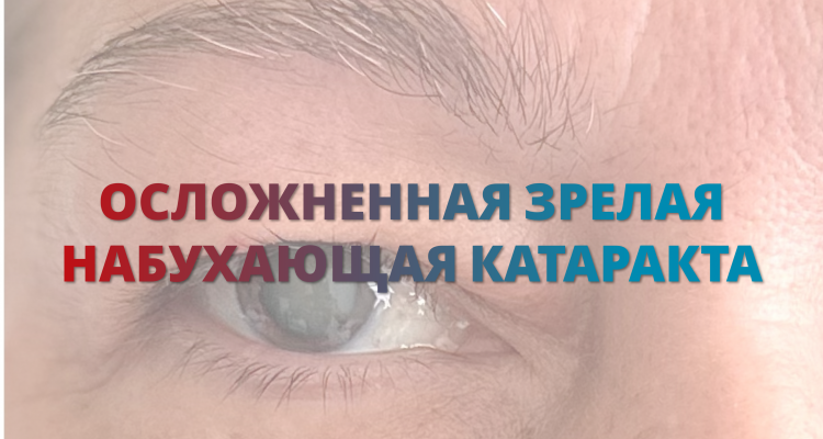 Лечение катаракты бесшовным методом